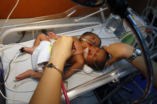 Dünyayı şaşırtan iki başlı bebek galerisi resim 3