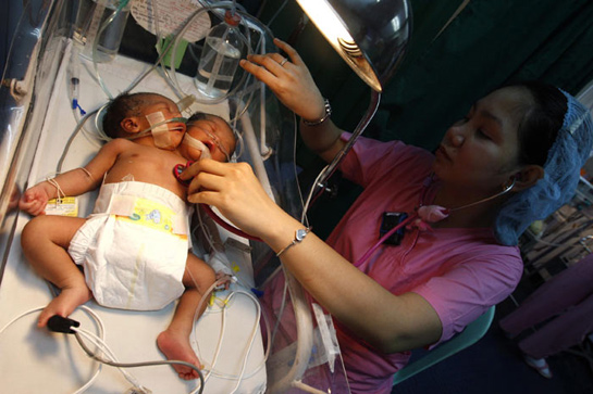 Dünyayı şaşırtan iki başlı bebek galerisi resim 4