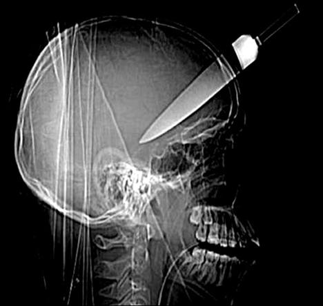 Şoke eden röntgen filmleri galerisi resim 1