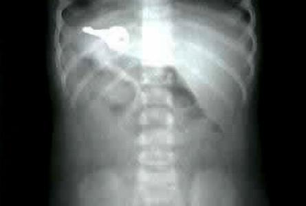 Şoke eden röntgen filmleri galerisi resim 10