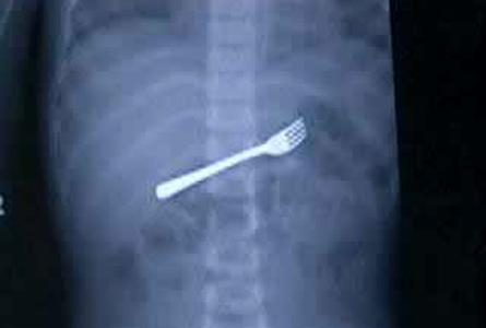 Şoke eden röntgen filmleri galerisi resim 11