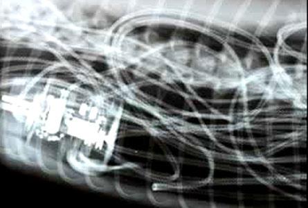 Şoke eden röntgen filmleri galerisi resim 12