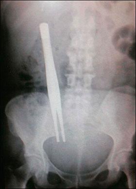 Şoke eden röntgen filmleri galerisi resim 13