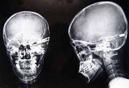 Şoke eden röntgen filmleri galerisi resim 14