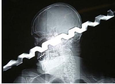 Şoke eden röntgen filmleri galerisi resim 17