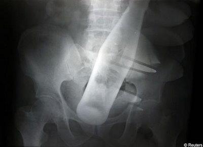 Şoke eden röntgen filmleri galerisi resim 18