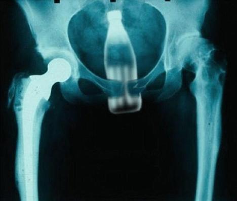 Şoke eden röntgen filmleri galerisi resim 19