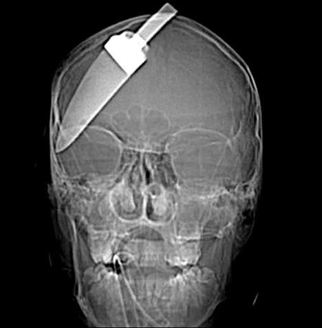 Şoke eden röntgen filmleri galerisi resim 2