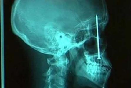 Şoke eden röntgen filmleri galerisi resim 3