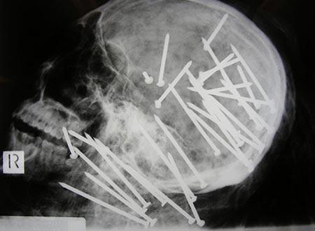 Şoke eden röntgen filmleri galerisi resim 4