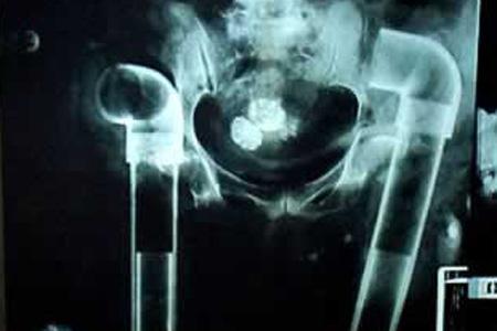 Şoke eden röntgen filmleri galerisi resim 9
