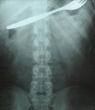 En ilginç tıbbi vakalar! galerisi resim 13