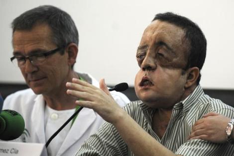 İşte tam yüz nakli yapılan hasta galerisi resim 2