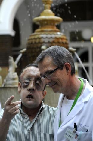 İşte tam yüz nakli yapılan hasta galerisi resim 5