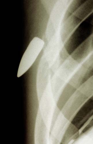 Bu röntgenler gerçek! galerisi resim 13