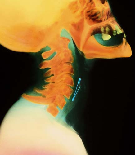 Bu röntgenler gerçek! galerisi resim 6