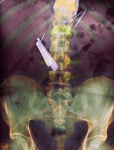 Bu röntgenler gerçek! galerisi resim 9