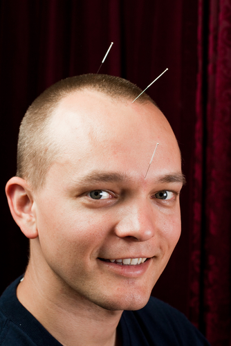 Akupunktur hakkında merak ettikleriniz... galerisi resim 4