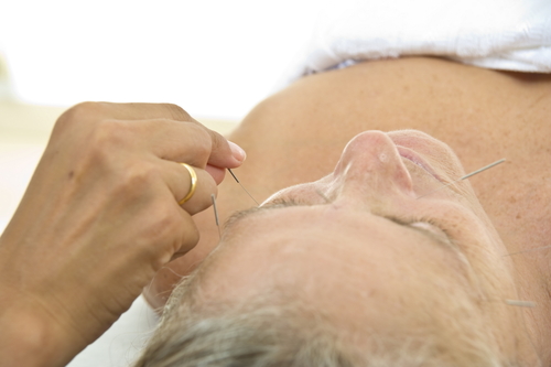 Akupunktur hakkında merak ettikleriniz... galerisi resim 6