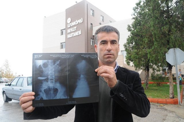 9 yıl karnında bıçakla yaşadı galerisi resim 1