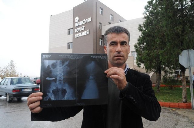 9 yıl karnında bıçakla yaşadı galerisi resim 2