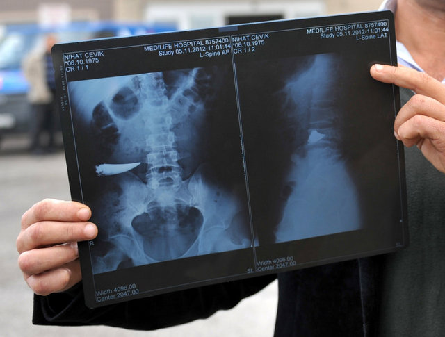 9 yıl karnında bıçakla yaşadı galerisi resim 3