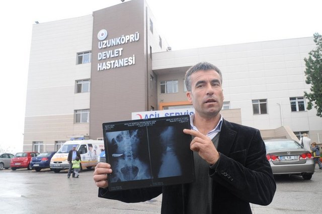 9 yıl karnında bıçakla yaşadı galerisi resim 4