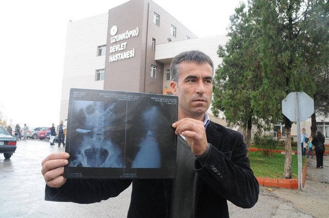 9 yıl karnında bıçakla yaşadı galerisi resim 5