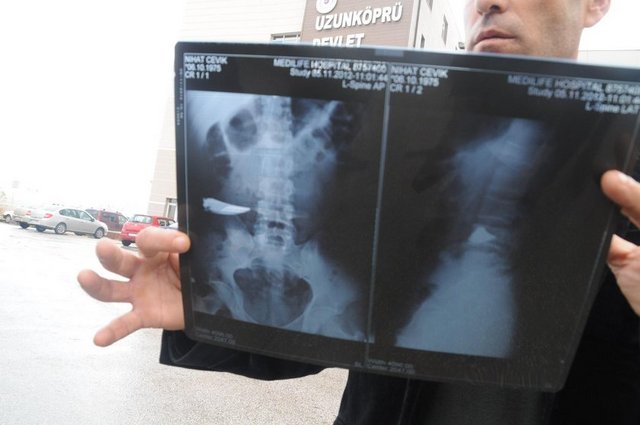 9 yıl karnında bıçakla yaşadı galerisi resim 6