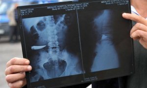 9 yıl karnında bıçakla yaşadı