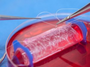 Laboratuvarda üretilen vajina başarıyla hastaya nakledildi