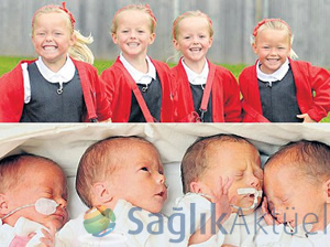 10 milyonda bir görülen çift ikiz bebekler