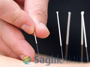 akupunktur ile yüksek tansiyon tedavisi