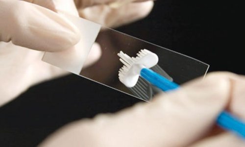 Rahim ağzı kanserinde HPV PCR testi ile erken teşhis!