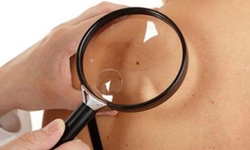 Agresif melanom için umut: Aşı vücudun kanserle savaşma potansiyelini açığa çıkarabilir