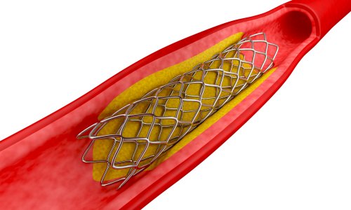 Eriyip yok olan stent eleştirilerle beraber geldi!