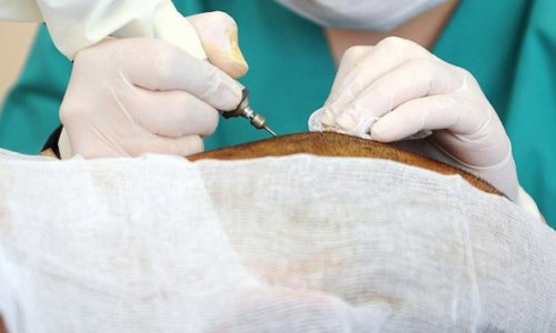 Saç ekiminde dünya birincisi olduk