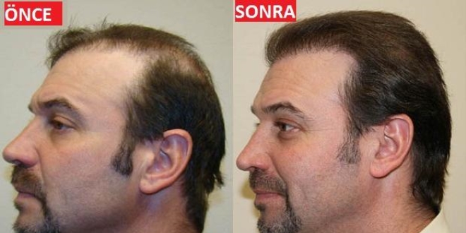 Stres Ve Genler Saclari Dokuyor