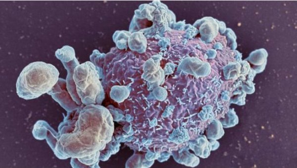 İlerlemiş kanserde yeni umut sıcak kemoterapi tedavisi