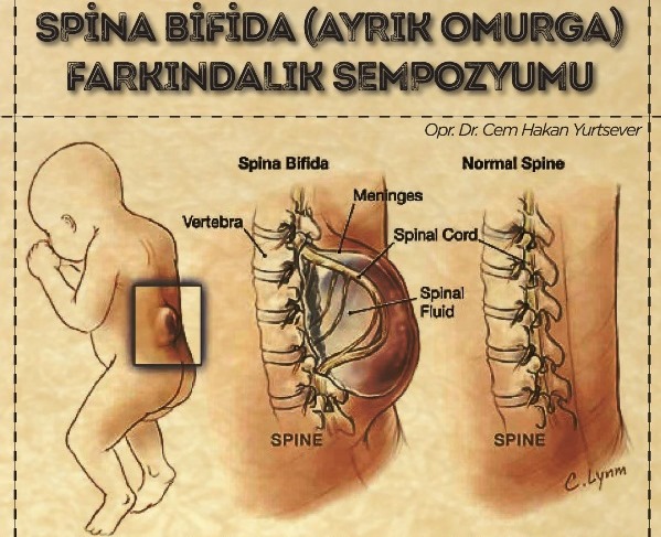 Spina Bifida (Ayrık Omurga) Farkındalık Sempozyumu