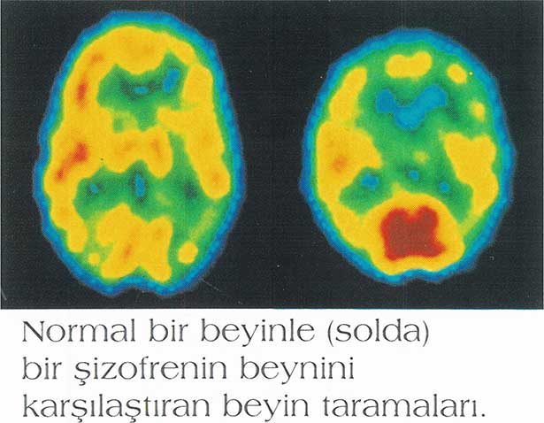 Şizofrenide beynin karar mekanizması bozuluyor