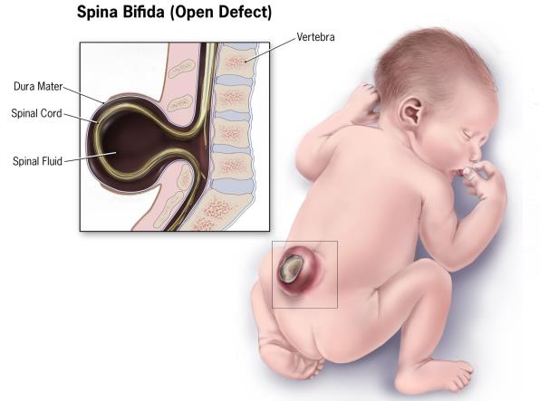 Folik asit eksikliği spina bifidanın ortaya çıkmasında etkili!