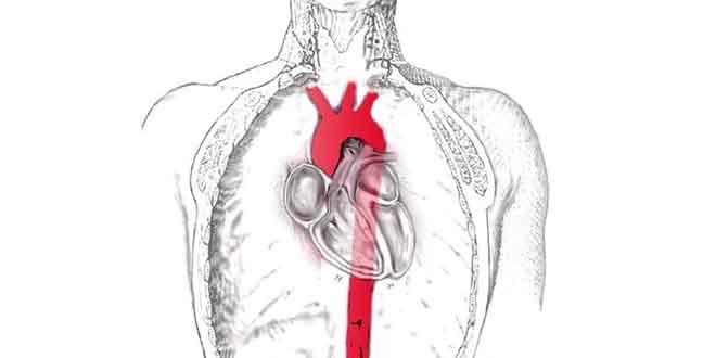 Bu kadar sağlam aort damarı nasıl yırtılır?