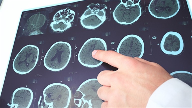 Epilepsi hastaları yeni geliştirilen 'hafıza çipi' ile tedavi edilebilecek