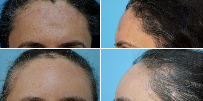 3D teknolojisiyle titanyumdan alın kemiği yapıldı