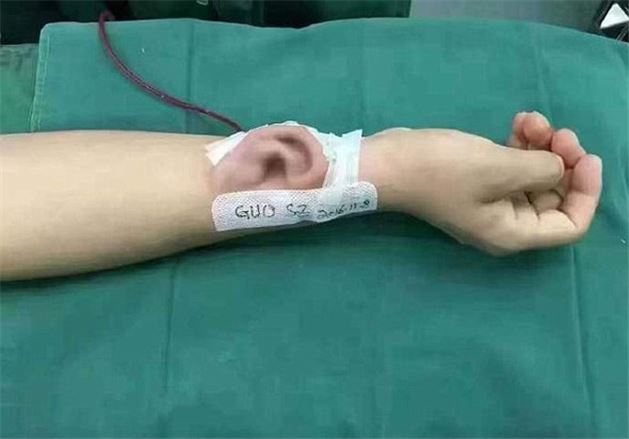 Çinli doktor, insan kolunda yapay kulak 'yetiştirdi