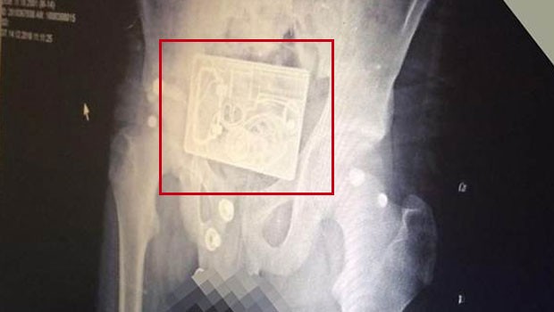 Röntgende çıkan cisim bomba paniği yaşattı