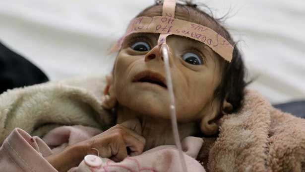 Yemen'de sağlık sistemi çöküyor!