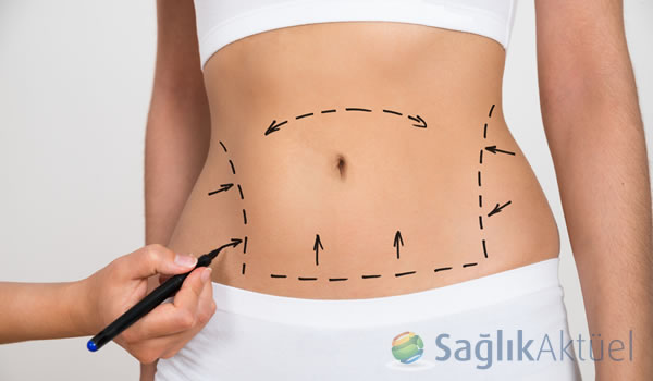 Liposuction nedir ne işe yarar?