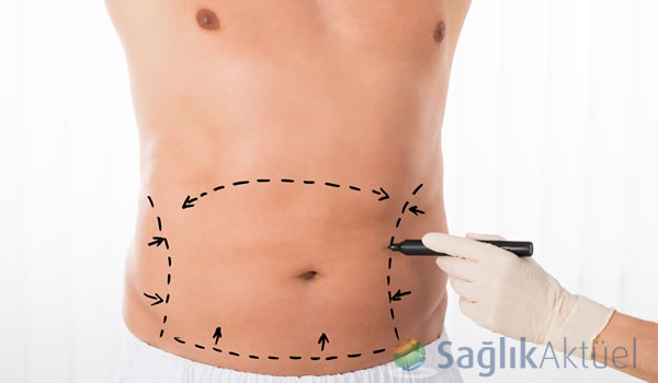 Sıkı vücuda karın germe ameliyatı ile kavuşabilirsiniz